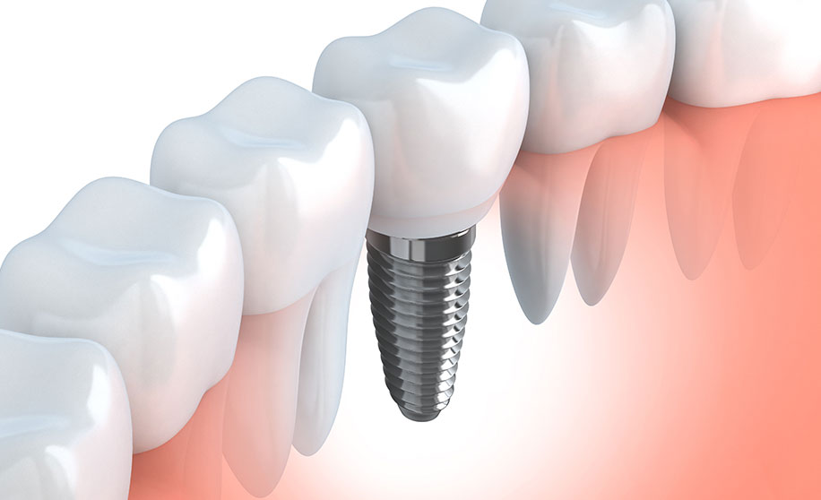 インプラントによる治療…インプラントを併用する義歯治療