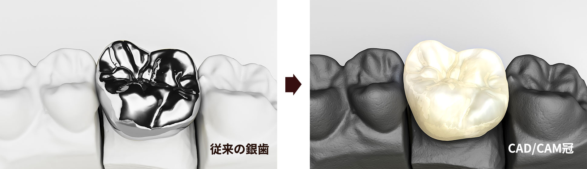 保険適用で歯の白い被せ物（CAD/CAM冠）ができるのをご存じですか？